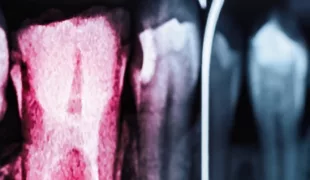 Endodontische Revision.