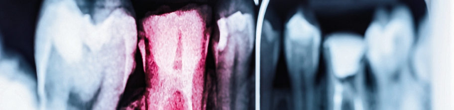 Endodontische Revision.