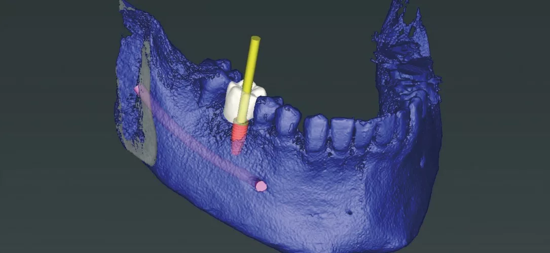 Abb. 1: Das Implantat wird entsprechend der Prothetik positioniert (coDiagnostiX 9.12, Dental Wings).
