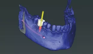 Abb. 1: Das Implantat wird entsprechend der Prothetik positioniert (coDiagnostiX 9.12, Dental Wings).