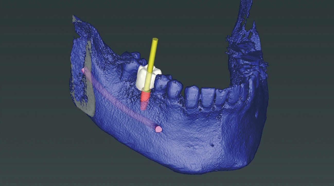 Abb. 1: Das Implantat wird entsprechend der Prothetik positioniert (coDiagnostiX 9.12, Dental Wings).