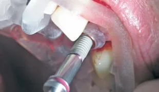 Insertion des Implantates durch die Schablone