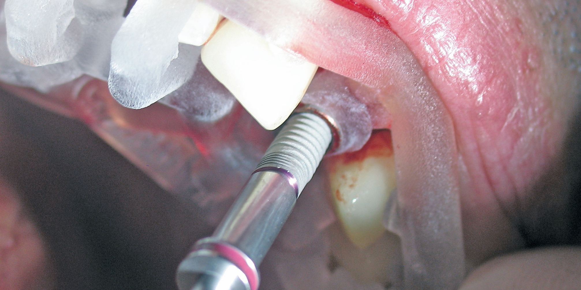 Insertion des Implantates durch die Schablone