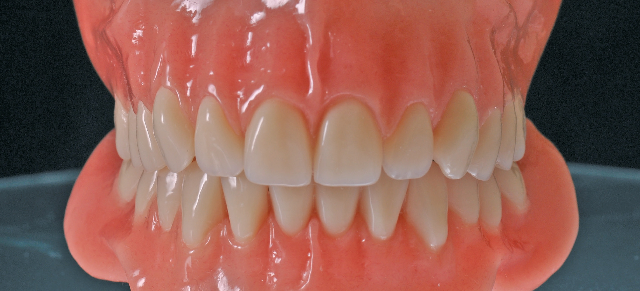 Totalprothesen nach dem Gerber-Aufstellsystem mit Muskelgriffigkeit im Gingivaanteil.