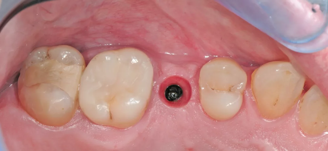 Trichterförmige Emergenz als optimale Basis für die Implantatkrone.