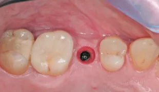 Trichterförmige Emergenz als optimale Basis für die Implantatkrone.