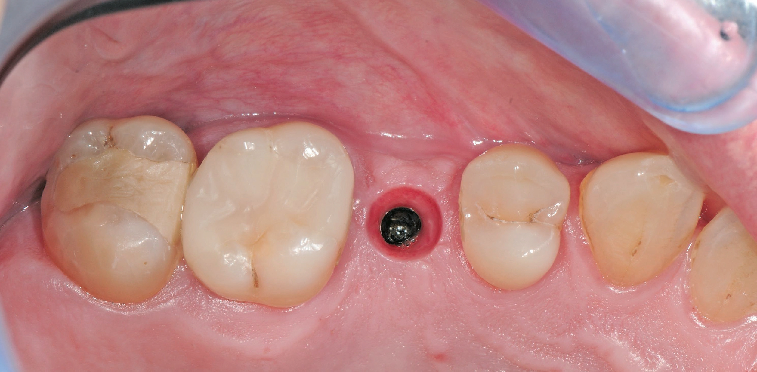 Trichterförmige Emergenz als optimale Basis für die Implantatkrone.