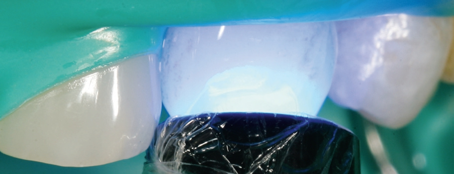 Härtungsverhalten verschiedener Dentalkomposite.