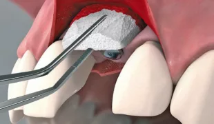 Geistlich Fibro-Gide® heißt die erste volumenstabile Kollagenmatrix zur Weichgewebeverdickung am Kieferkamm.