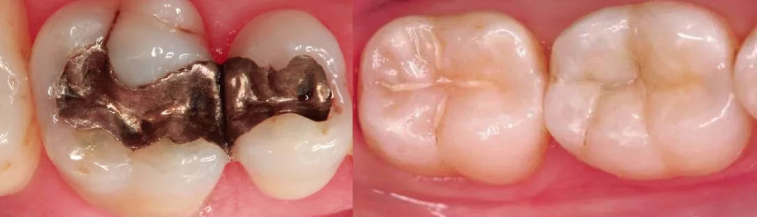 Kompositkunststoffen und Amalgam.