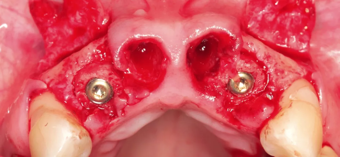 Implantation von zwei Knochenringen.