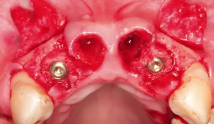 Implantation von zwei Knochenringen.