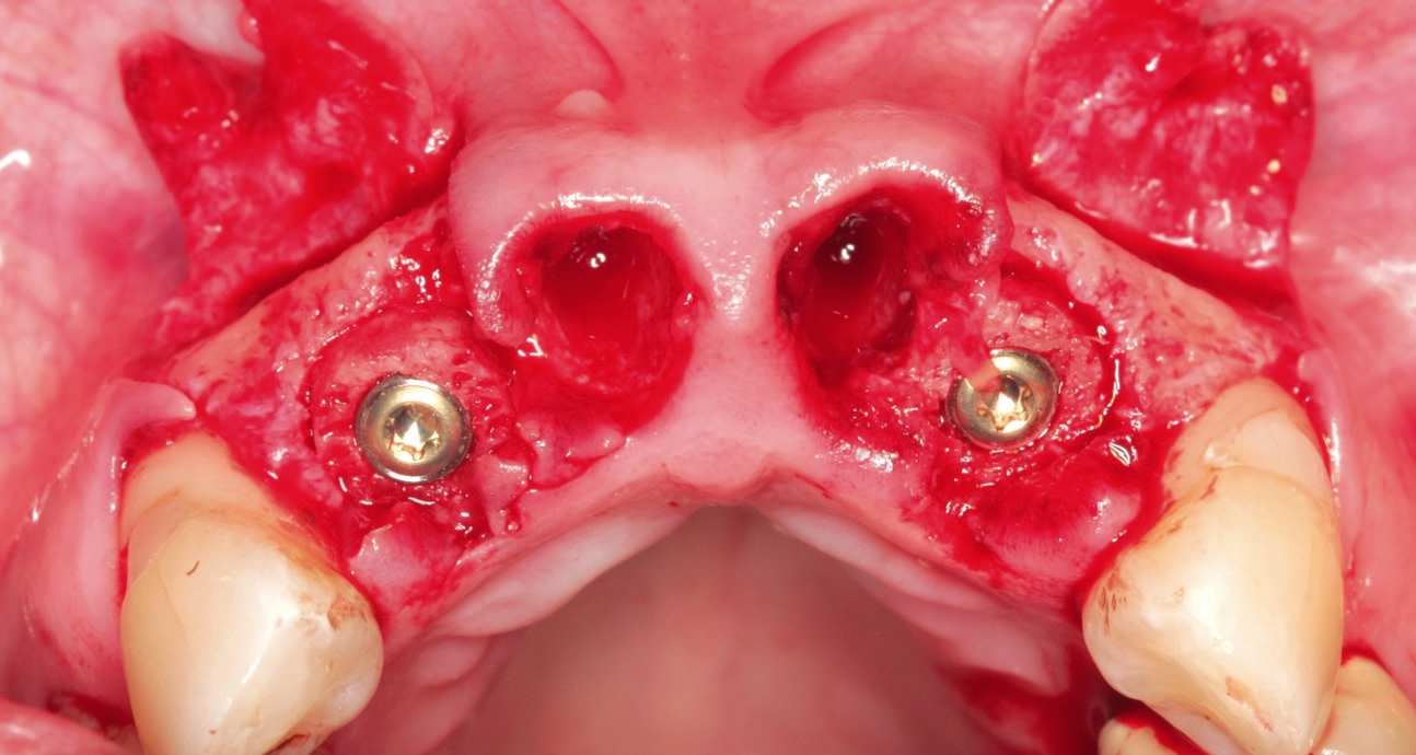 Implantation von zwei Knochenringen.