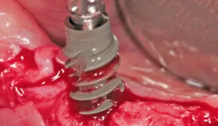 Straumann® BLX Roxolid® SLActive® mit Durchmesser von 4,5 mm und Länge von 10 mm.