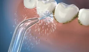 Effektive Interdentalreinigung mit der Waterpik® Munddusche.