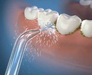 Effektive Interdentalreinigung mit der Waterpik® Munddusche.
