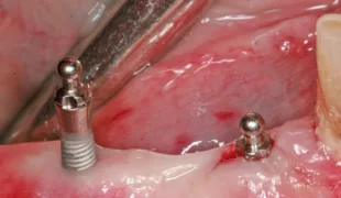 Transgingivale Insertion der Implantate