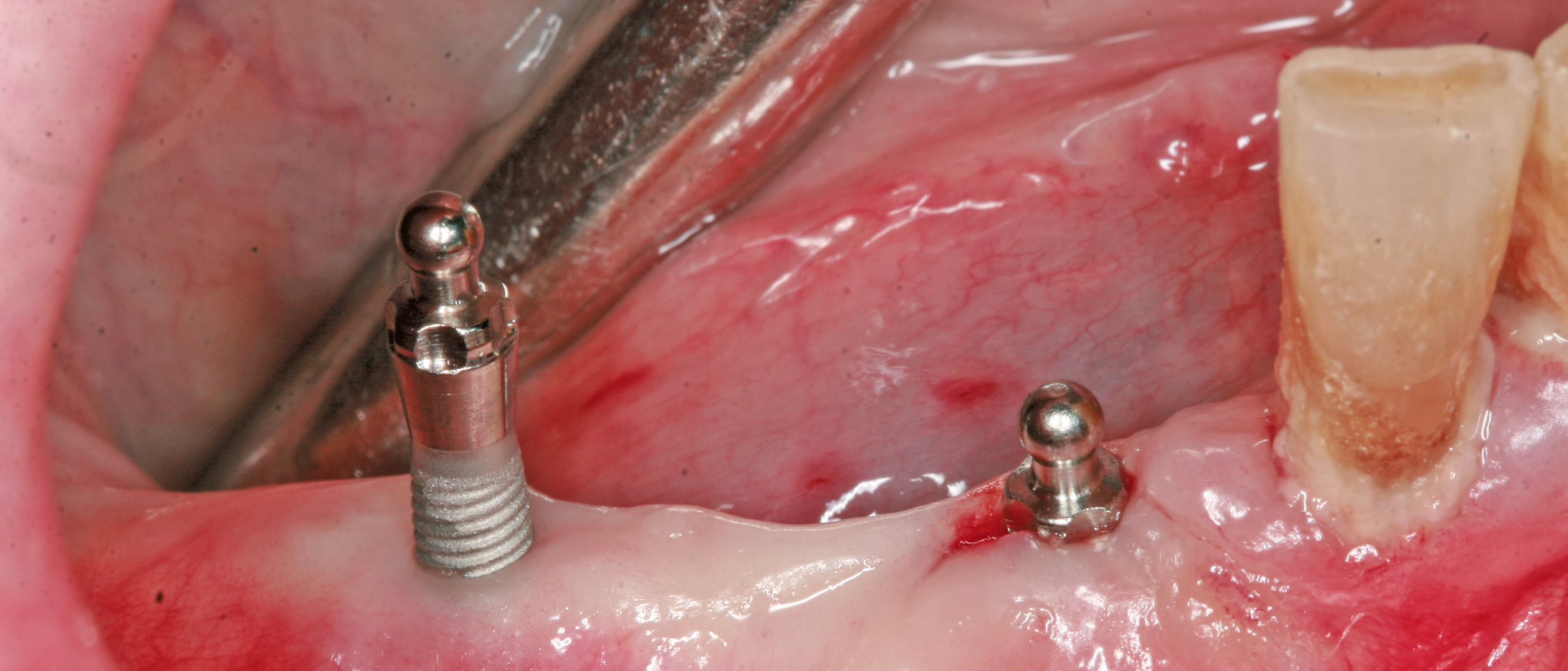 Transgingivale Insertion der Implantate