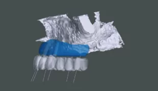 Patientenspezifische Planung der allogenen Transplantate.
