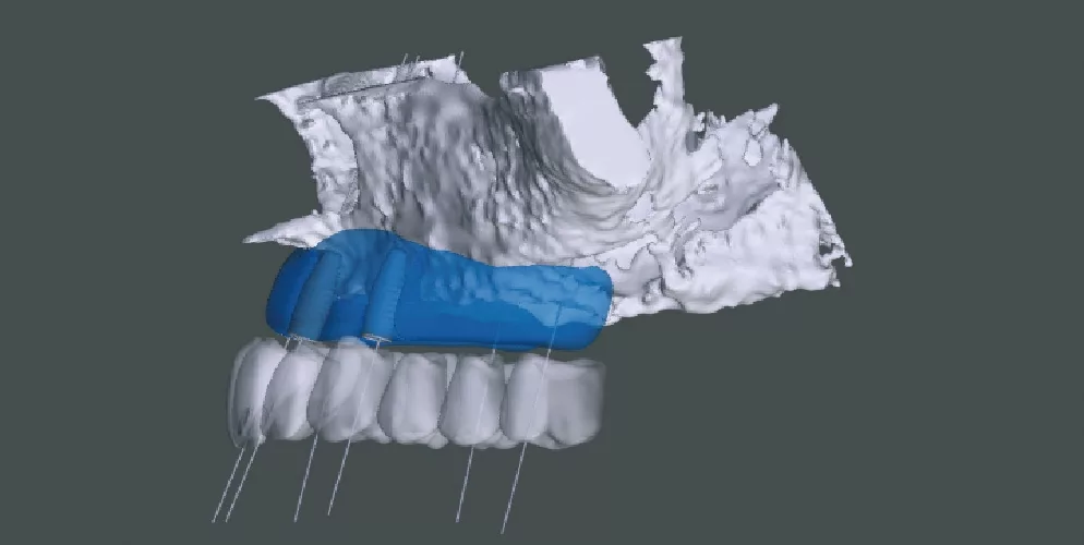 Patientenspezifische Planung der allogenen Transplantate.