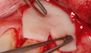 Applikation der rehydrierten und in Form geschnittenen mucoderm® Matrix.