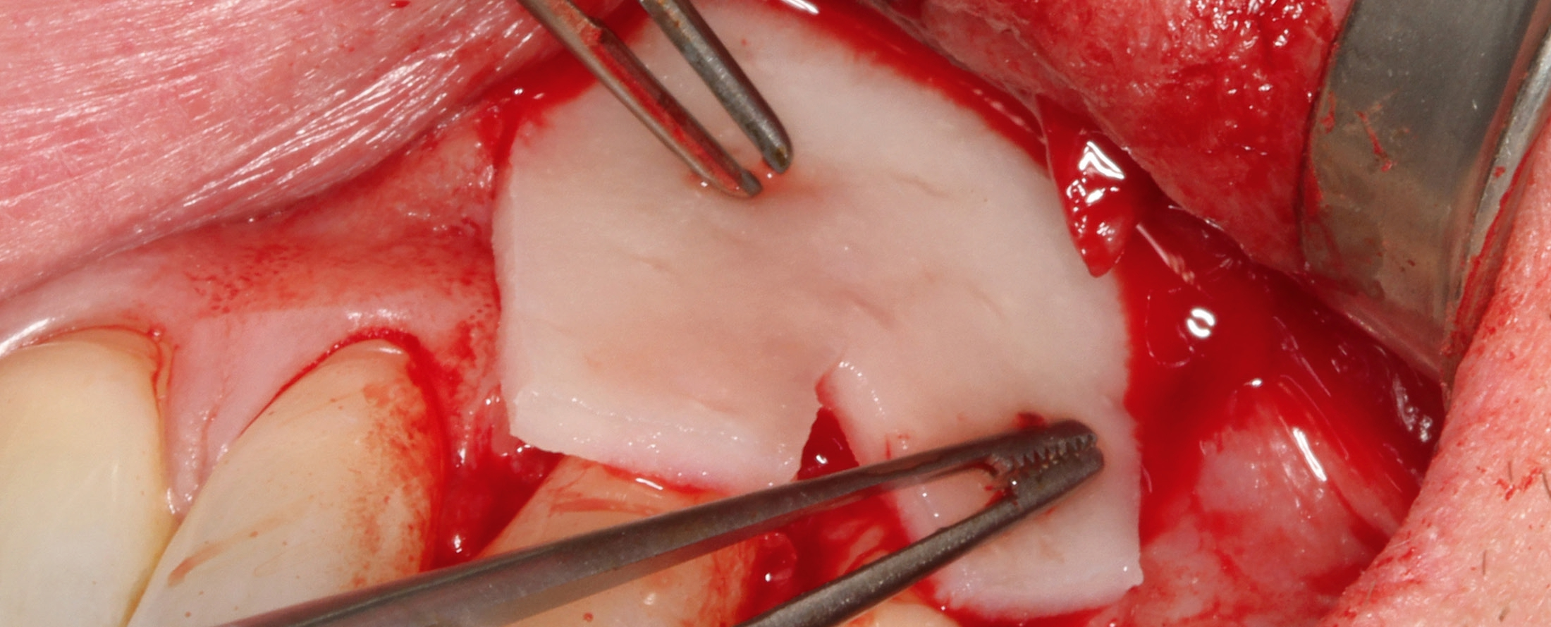 Applikation der rehydrierten und in Form geschnittenen mucoderm® Matrix.