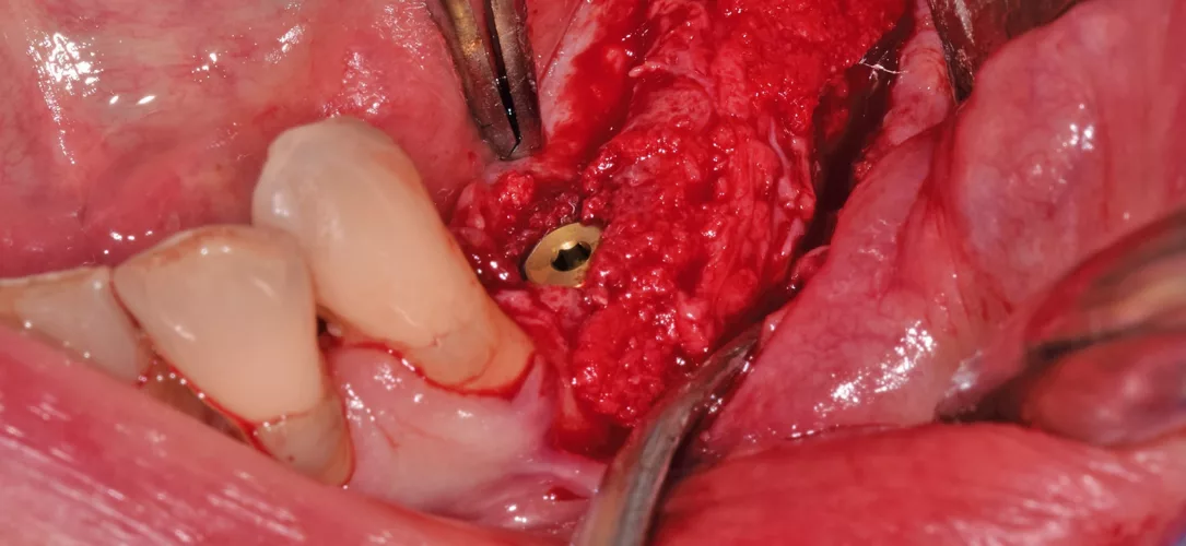 Implantation mit Bohrschablone; nicht full guided.