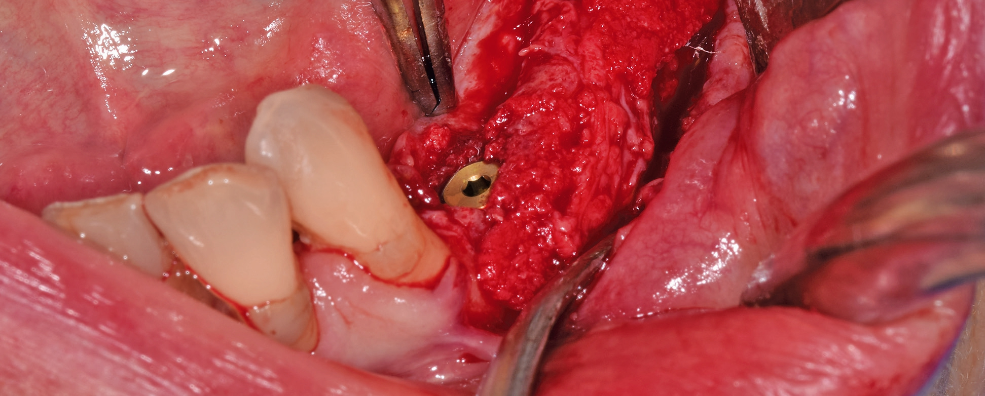Implantation mit Bohrschablone; nicht full guided.