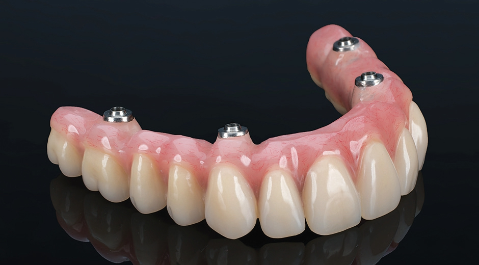 Permadental erwartet Anstieg von Implantat-Versorgungen für zahnlose Kiefer.