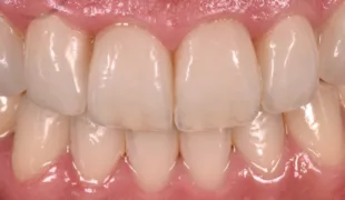 Sechs Veneers aus zirkonoxidverstärktem Lithiumsilikat (ZLS) in der Oberkieferfront (13 bis 23) bei der Anprobe mit Kakaobutter im Mund des Patienten (ZLS: Celtra Press, Verblendkeramik: Celtra Ceram, Dentsply Sirona Lab).