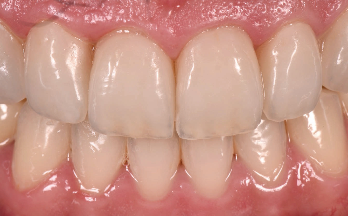 Sechs Veneers aus zirkonoxidverstärktem Lithiumsilikat (ZLS) in der Oberkieferfront (13 bis 23) bei der Anprobe mit Kakaobutter im Mund des Patienten (ZLS: Celtra Press, Verblendkeramik: Celtra Ceram, Dentsply Sirona Lab).