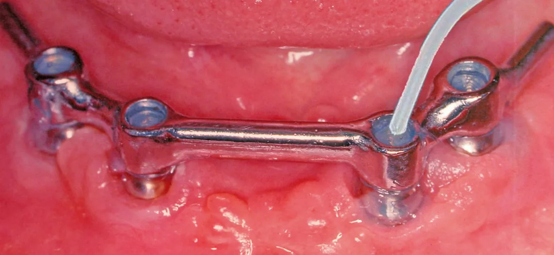 Auffüllen einer Implantat getragenen Stegkonstruktion mit GapSeal® im Unterkiefer.