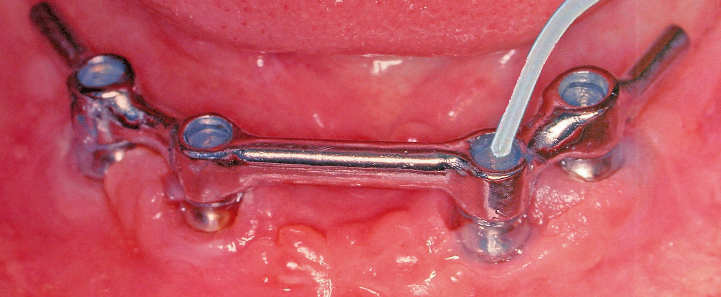 Auffüllen einer Implantat getragenen Stegkonstruktion mit GapSeal® im Unterkiefer.