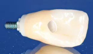 Zur Ästhetik- und Funktionseinprobe wurden das PEKK-Abutment, die Laborschraube und die Zirkoniumdioxidkrone angeliefert.