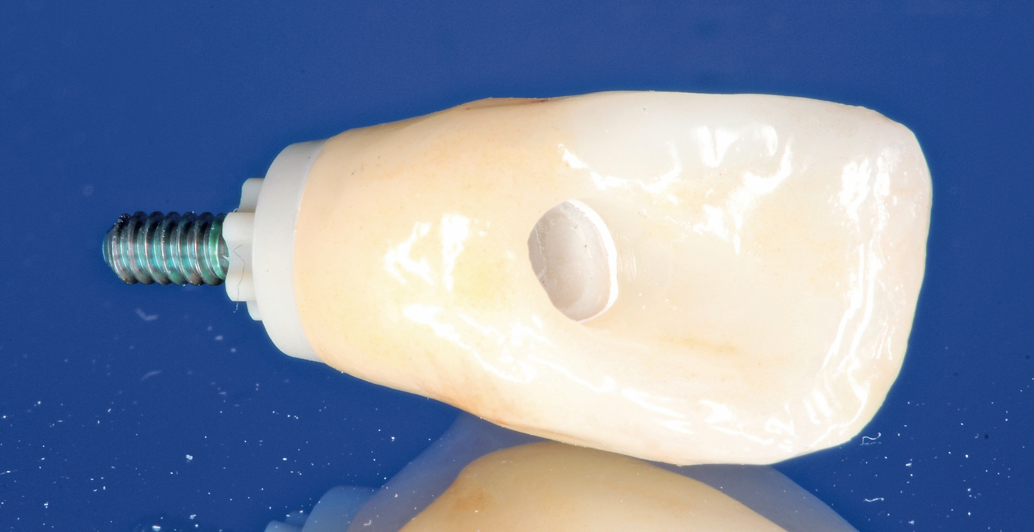Zur Ästhetik- und Funktionseinprobe wurden das PEKK-Abutment, die Laborschraube und die Zirkoniumdioxidkrone angeliefert.