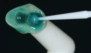Monobond Etch&Prime wirkt auf einer Lithiumdisilikat-Teilkrone ein.