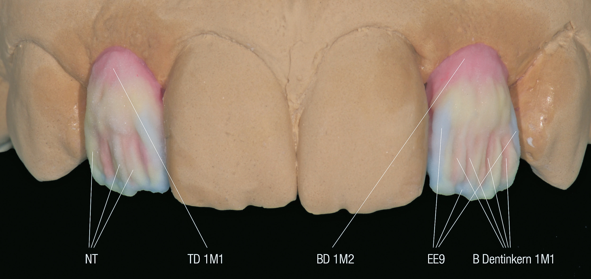 Nach der sorgfältigen Farbanalyse und Skizzierung des Schichtschemas kommt im Frontzahnbereich die ganze Palette zum Einsatz, um beim Eingliederungstermin „Ja!“ sagen zu können, „wir haben die bestmögliche Leistung abgerufen.“