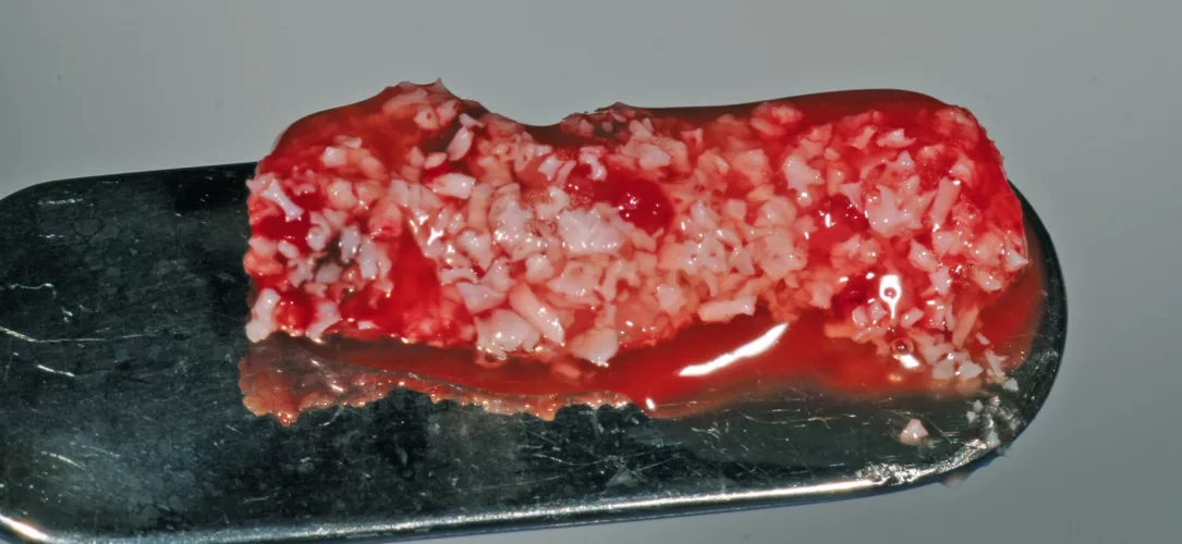 Klebrige modulierbare PRF-Knochenersatzmaterialmischung.
