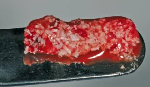 Klebrige modulierbare PRF-Knochenersatzmaterialmischung.
