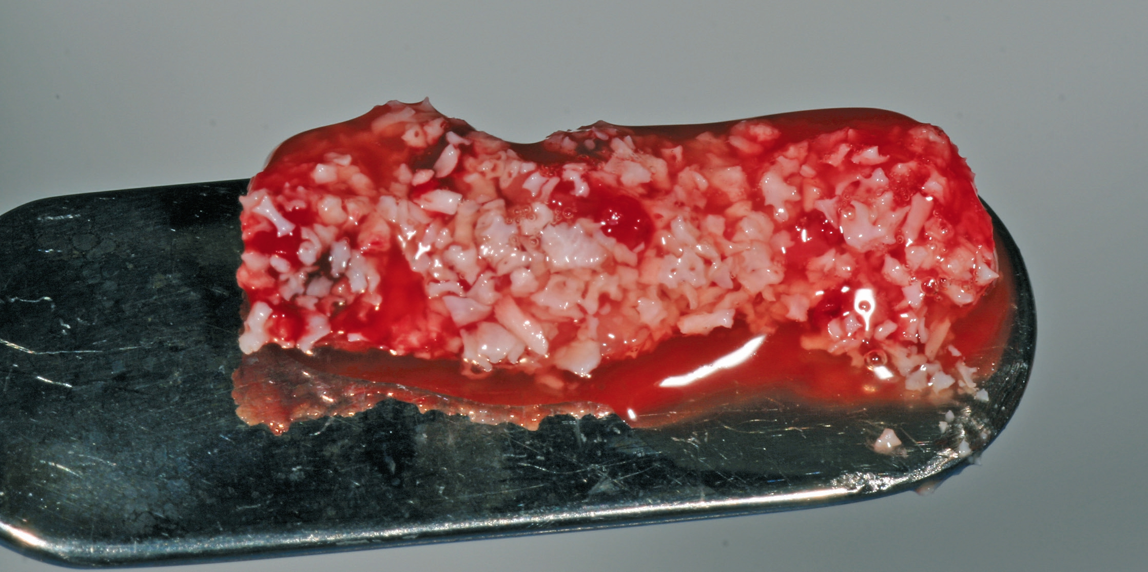 Klebrige modulierbare PRF-Knochenersatzmaterialmischung.
