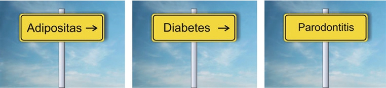 Indirekter Einfluss von Adipositas auf Parodontitis über Diabetes mellitus.