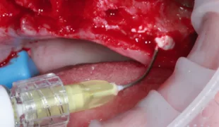 Abb. 1: Applikation der Cerasorb® Paste in eine Extraktionsalveole.