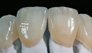 Ultradünne Veneers aus der Presskeramik VITA AMBRIA im Zusammenspiel mit der Verblendkeramik VITA LUMEX AC.