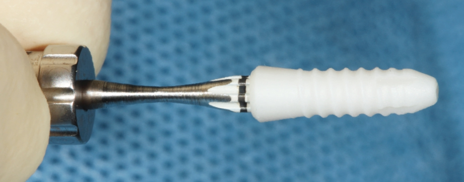 Keramikimplantat.