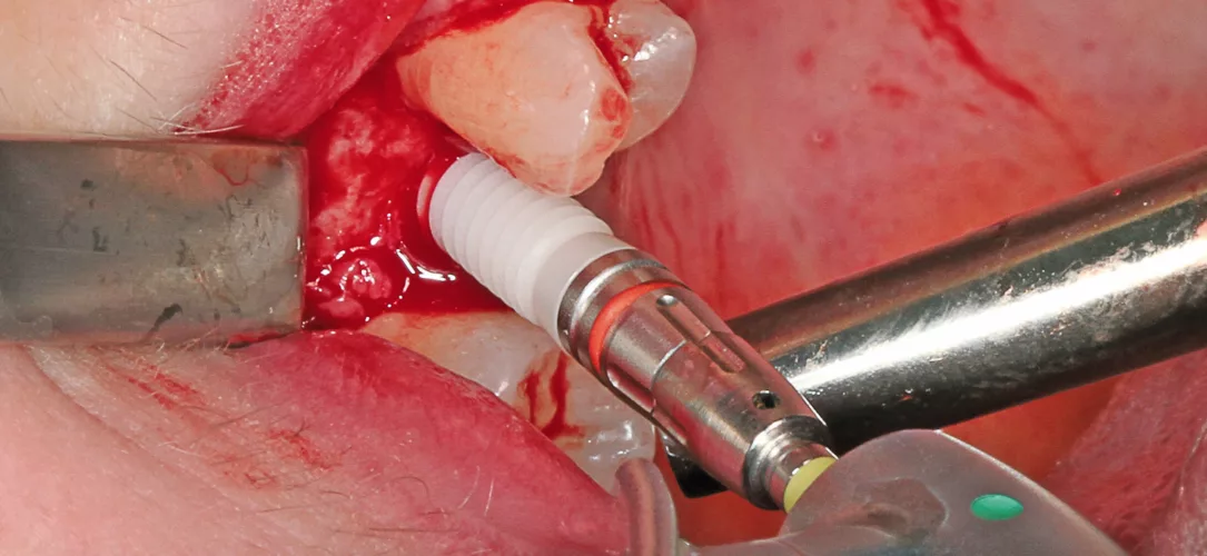 Das ceramic.implant wurde mit niedriger Drehzahl auf die geplante Tiefe gebracht.