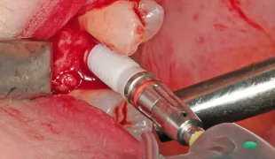 Das ceramic.implant wurde mit niedriger Drehzahl auf die geplante Tiefe gebracht.
