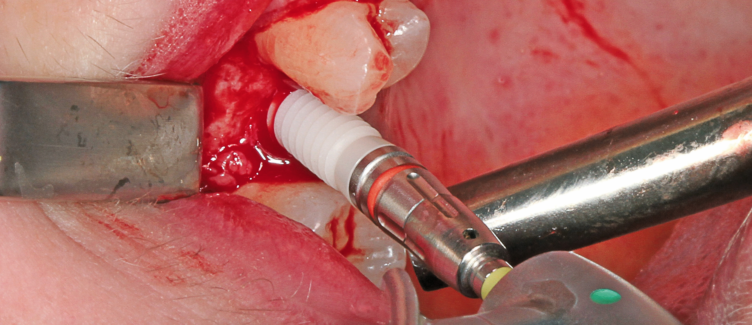 Das ceramic.implant wurde mit niedriger Drehzahl auf die geplante Tiefe gebracht.