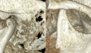 Fusion von zwei DVT-Aufnahmen des linken Kiefergelenks.