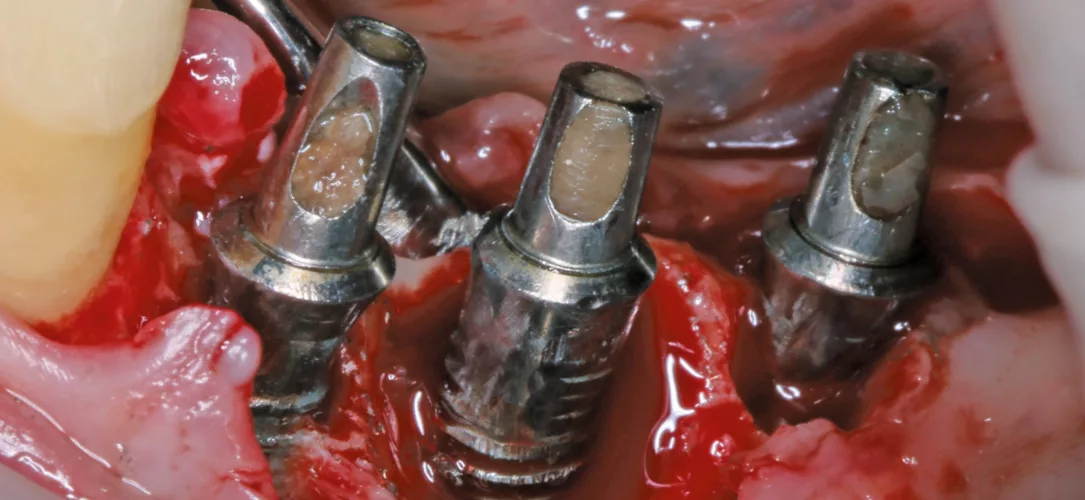 Klinisches Bild einer Periimplantitis.