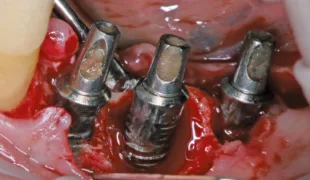 Klinisches Bild einer Periimplantitis.